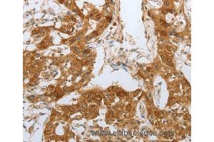 Immunohistochemistry of Human lung cancer using NPY1R Polyclonal Antibody at dilution of 1:25 (NPY1R antibody)