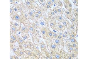 Immunohistochemistry of paraffin-embedded Human liver cancer using PTGS1 Polyclonal Antibody at dilution of 1:100 (40x lens). (PTGS1 antibody)