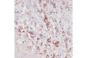Immunohistochemistry of paraffin-embedded human liver cancer using Lysozyme (Lysozyme (LYZ)) antibody (ABIN6133802, ABIN6143409, ABIN6143412 and ABIN6217538) at dilution of 1:100 (40x lens). (LYZ antibody  (AA 1-100))