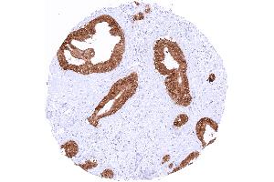 Ductal adenocarcinoma of the pancreas with strong TFF1 staining of all tumor cells (TFF1 antibody  (AA 1-88))