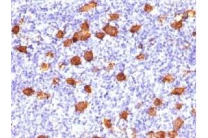 IHC testing of FFPE human Hodgkin's lymphoma stained with CD30 antibody.