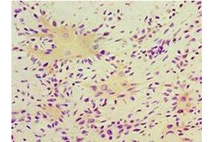 Immunohistochemistry of paraffin-embedded human breast cancer using ABIN7166413 at dilution of 1:100 (Transglutaminase 2 antibody  (AA 438-687))