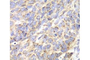 Immunohistochemistry of paraffin-embedded Human esophageal cancer using ACY1 Polyclonal Antibody at dilution of 1:100 (40x lens). (Aminoacylase 1 antibody)