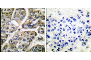 Immunohistochemical analysis of paraffin-embedded human breast carcinoma tissue using Granzyme B antibody. (GZMB antibody)