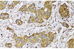 Immunohistochemistry of paraffin-embedded Human liver cancer using UGDH Polyclonal Antibody at dilution of 1:100 (40x lens). (UGDH antibody)