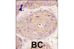 Formalin-fixed and paraffin-embedded human breast carcinoma tissue reacted with GGPS1 polyclonal antibody  , which was peroxidase-conjugated to the secondary antibody, followed by DAB staining . (GGPS1 antibody  (C-Term))