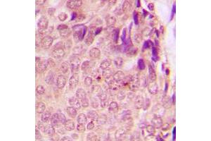 Immunohistochemical analysis of STAT3 (pS727) staining in human breast cancer formalin fixed paraffin embedded tissue section. (STAT3 antibody  (C-Term, pSer727))