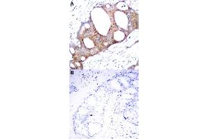 Immunohistochemical staining of human breast cancer tissue by GSK3A (phospho S21) polyclonal antibody  without blocking peptide (A) or preincubated with blocking peptide (B) under 1:50-1:100 dilution. (GSK3 alpha antibody  (pSer21))