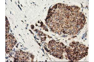 Immunohistochemical staining of paraffin-embedded Adenocarcinoma of Human breast tissue using anti-CLPP mouse monoclonal antibody. (CLPP antibody)