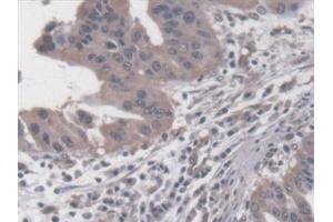 Detection of RDX in Human Liver cancer Tissue using Polyclonal Antibody to Radixin (RDX) (Radixin antibody  (AA 5-295))