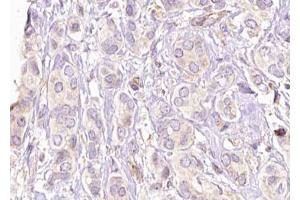 ABIN6269189 at 1/100 staining Human breast cancer tissue by IHC-P.