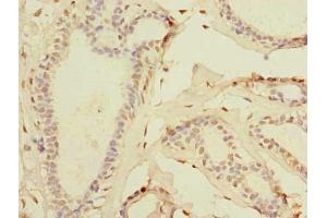Immunohistochemistry of paraffin-embedded human breast cancer using ABIN7171935 at dilution of 1:100
