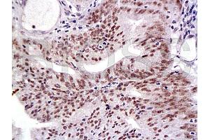 Formalin-fixed and paraffin embedded human endometrium tissue labeled with Anti-MLH-1 Polyclonal Antibody, Unconjugated (ABIN728833) at 1:200, followed by conjugation to the secondary antibody and DAB staining (MLH1 antibody  (AA 501-600))