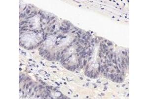 Immunohistochemistry analysis of paraffin-embedded human colon cancer using PARN (ABIN7075117) at dilution of 1: 1800 (PARN antibody)