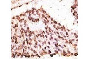 IHC analysis of FFPE human breast carcinoma tissue stained with the MMP7 antibody (MMP7 antibody  (AA 117-146))