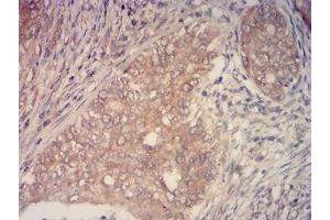 Immunohistochemical analysis of paraffin-embedded cervical cancer tissues using KMT2C mouse mAb with DAB staining. (MLL3 antibody  (AA 1-205))