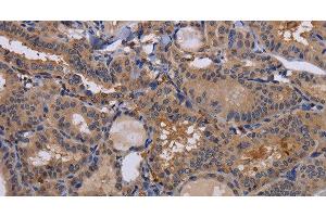 Immunohistochemistry of paraffin-embedded Human thyroid cancer using FADS1 Polyclonal Antibody at dilution of 1:60 (FADS1 antibody)