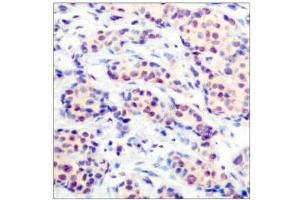 Immunohistochemical analysis of paraffin-embedded human breast carcinoma tissue using JunD (Ab-255) antibody (E021028). (JunD antibody)
