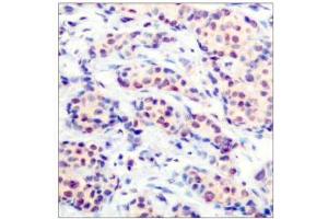 Immunohistochemical analysis of paraffin-embedded human breast carcinoma tissue using JunD (Ab-255) antibody (E021028).
