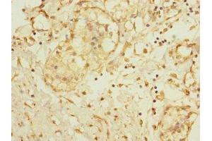 Immunohistochemistry of paraffin-embedded human breast cancer using ABIN7150051 at dilution of 1:100 (ADAM28 antibody  (AA 199-440))