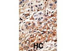 Formalin-fixed and paraffin-embedded human cancer tissue reacted with the primary antibody, which was peroxidase-conjugated to the secondary antibody, followed by DAB staining. (BMF antibody  (AA 115-150))