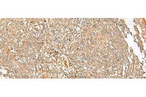 Immunohistochemistry of paraffin-embedded Human tonsil tissue using FGL2 Polyclonal Antibody at dilution of 1:45(x200) (FGL2 antibody)