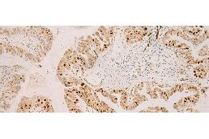 Immunohistochemistry of paraffin-embedded Human liver cancer tissue using RFX6 Polyclonal Antibody at dilution of 1:50(x200) (RFX6 antibody)