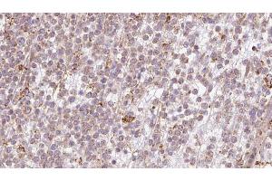 ABIN6273200 at 1/100 staining Human lymph cancer tissue by IHC-P. (BBS10 antibody  (Internal Region))