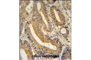 S1 antibody (N-term) (ABIN654456 and ABIN2844190) immunohistochemistry analysis in formalin fixed and paraffin embedded human colon carcinoma followed by peroxidase conjugation of the secondary antibody and DAB staining.