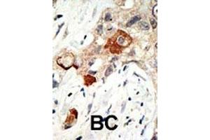 Formalin-fixed and paraffin-embedded human cancer tissue reacted with the primary antibody, which was peroxidase-conjugated to the secondary antibody, followed by AEC staining. (UBE2I antibody  (N-Term))