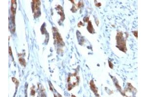 Immunohistochemical staining (Formalin-fixed paraffin-embedded sections) of human stomach carcinoma with MUC5AC monoclonal antibody, clone 58M1 . (MUC5AC antibody)