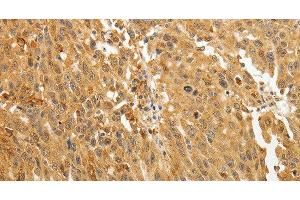 Immunohistochemistry of paraffin-embedded Human ovarian cancer using AKR1A1 Polyclonal Antibody at dilution of 1:30 (AKR1A1 antibody)