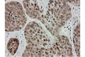 Immunohistochemical staining of paraffin-embedded Adenocarcinoma of Human breast tissue using anti-SMS mouse monoclonal antibody.