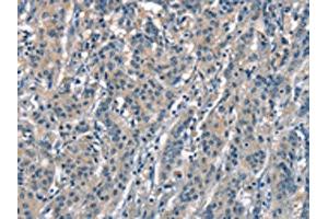 The image on the left is immunohistochemistry of paraffin-embedded Human gastric cancer tissue using ABIN7189631(ACPT Antibody) at dilution 1/30, on the right is treated with synthetic peptide. (Testicular Acid Phosphatase (ACP4) antibody)