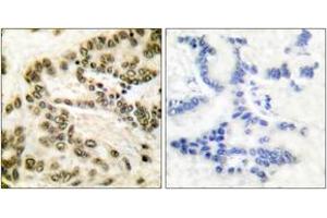 Immunohistochemistry analysis of paraffin-embedded human lung carcinoma tissue, using CREB (Ab-142) Antibody. (CREB1 antibody  (AA 111-160))