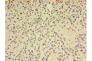 Immunohistochemistry of paraffin-embedded human breast cancer using ABIN7143455 at dilution of 1:100 (ARF6 antibody  (AA 1-175))