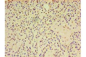 Immunohistochemistry of paraffin-embedded human breast cancer using ABIN7143455 at dilution of 1:100