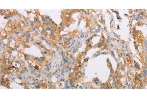 Immunohistochemistry of paraffin-embedded Human thyroid cancer tissue using ACTR2 Polyclonal Antibody at dilution 1:40 (ACTR2 antibody)
