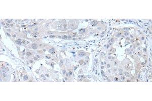 Immunohistochemistry of paraffin-embedded Human esophagus cancer tissue using ANGPTL6 Polyclonal Antibody at dilution of 1:55(x200) (ANGPTL6 antibody)