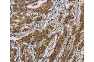 Immunohistochemistry of Human gastric cancer using IL5RA Polyclonal Antibody at dilution of 1:40 (IL5RA antibody)