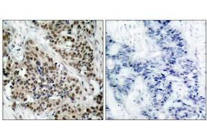 Immunohistochemical analysis of paraffin- embedded human breast carcinoma tissue using FKHR (phospho-Ser256) antibody (E011115). (FOXO1 antibody  (pSer256))