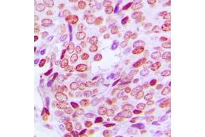 Immunohistochemical analysis of PFDN1 staining in human prostate cancer formalin fixed paraffin embedded tissue section. (PFDN1 antibody  (N-Term))