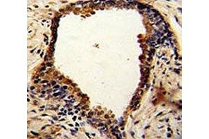 IHC analysis of FFPE human prostate carcinoma with NDRG1 antibody (NDRG1 antibody  (AA 12-40))