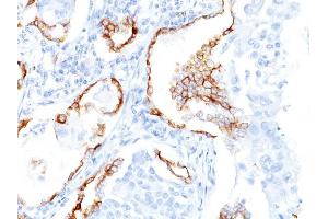 Formalin-fixed, paraffin-embedded human Lung SCC stained with Cytokeratin 7 Mouse Monoclonal Antibody (K72. (Cytokeratin 7 antibody)