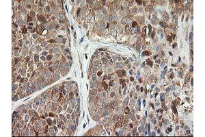 Immunohistochemical staining of paraffin-embedded Adenocarcinoma of Human breast tissue using anti-LSM1 mouse monoclonal antibody. (LSM1 antibody)