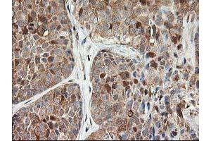 Immunohistochemical staining of paraffin-embedded Adenocarcinoma of Human breast tissue using anti-LSM1 mouse monoclonal antibody.