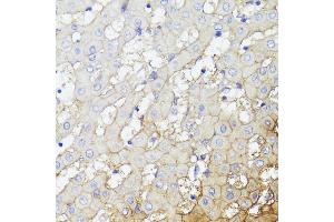 Immunohistochemistry of paraffin-embedded Human liver cancer using CD276/B7-H3 antibody (ABIN7266182) at dilution of 1:100 (40x lens). (CD276 antibody  (AA 100-200))