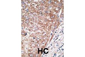 Formalin-fixed and paraffin-embedded human hepatocellular carcinoma tissue reacted with NEUROD1 polyclonal antibody  , which was peroxidase-conjugated to the secondary antibody, followed by DAB staining. (NEUROD1 antibody  (N-Term))