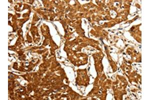 The image on the left is immunohistochemistry of paraffin-embedded Human lung cancer tissue using ABIN7128859(CDH23 Antibody) at dilution 1/80, on the right is treated with fusion protein. (CDH23 antibody)