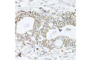 Immunohistochemistry of paraffin-embedded human gastric cancer using ATP1B1 antibody (ABIN5973412) at dilution of 1/100 (40x lens). (ATP1B1 antibody)